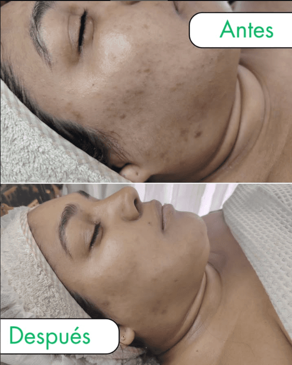 Resultado real de tratamiento estético - Eugenia Style Antes y Después 1
