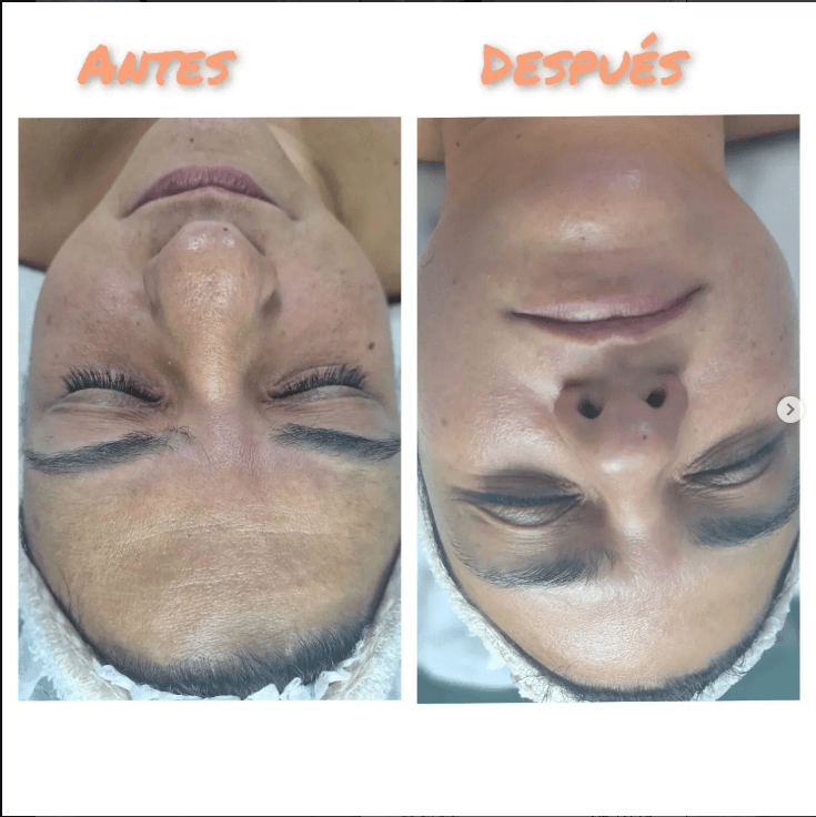 Resultado real de tratamiento estético - Eugenia Style Antes y Después 3