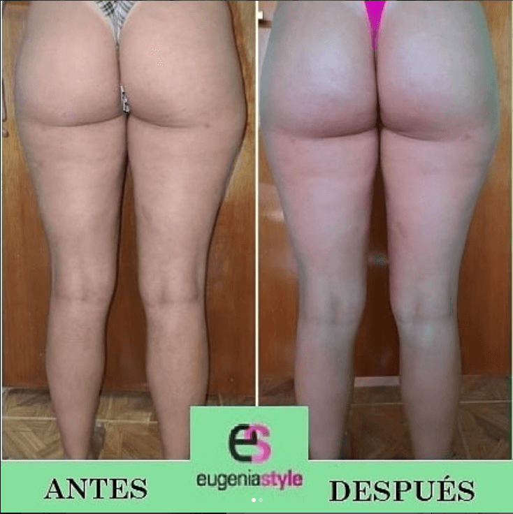Resultado real de tratamiento estético - Eugenia Style Antes y Después 9