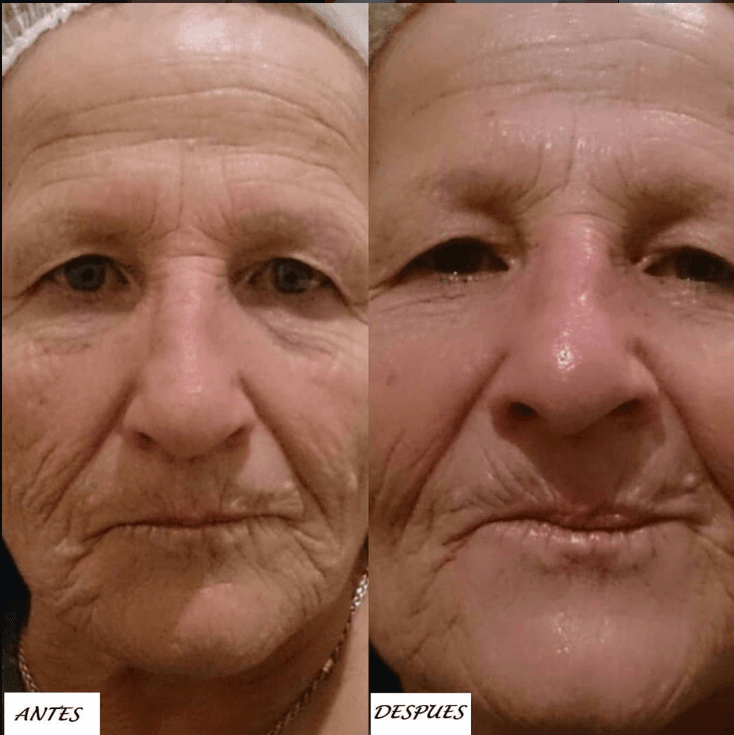Resultado real de tratamiento estético - Eugenia Style Antes y Después 13