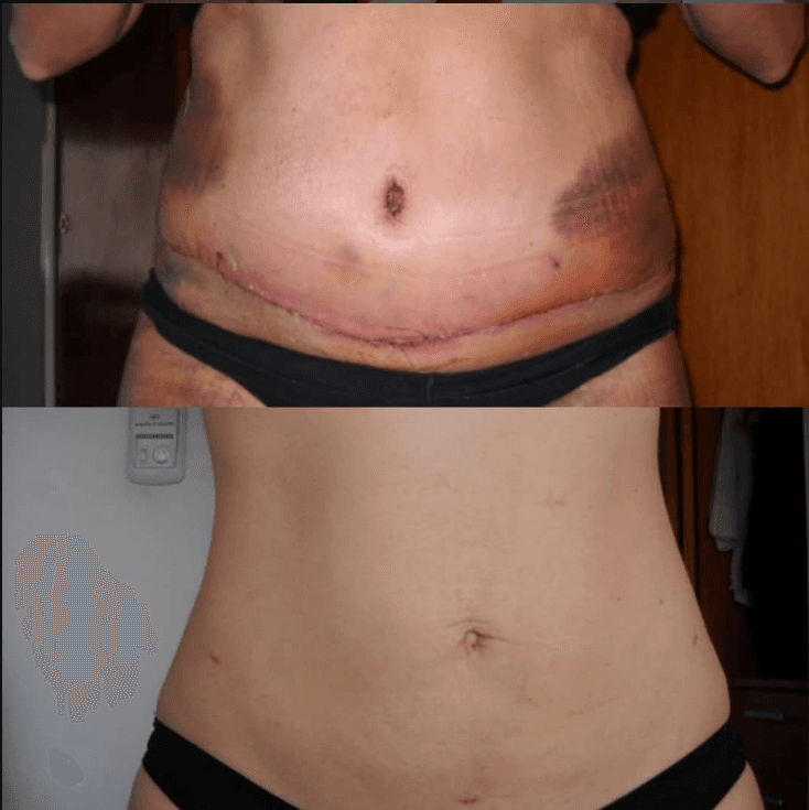 Resultado real de tratamiento estético - Eugenia Style Antes y Después 15